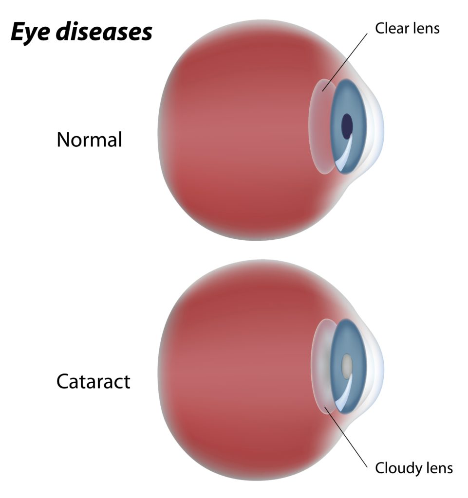 Cataract-chart - Hinsdale Eye Center